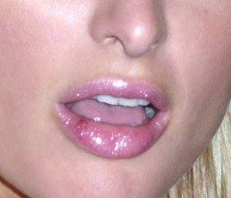 cold sores